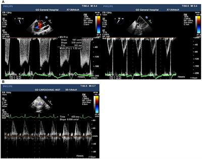 Case Series: Video-Assisted Minimally Invasive Cardiac Surgery During Pregnancy